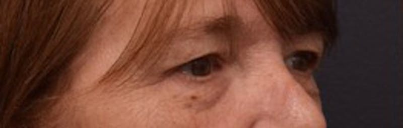 Face Before & After Gallery - Patient 63361203 - Image 3