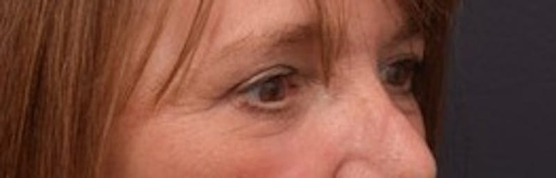 Face Before & After Gallery - Patient 63361203 - Image 4