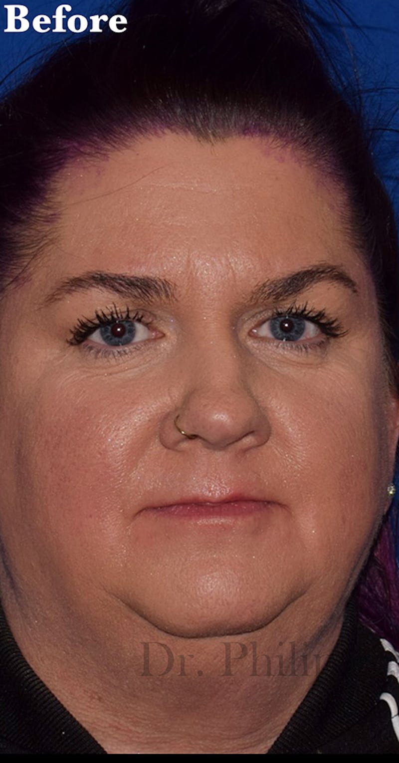Face Before & After Gallery - Patient 63361217 - Image 1