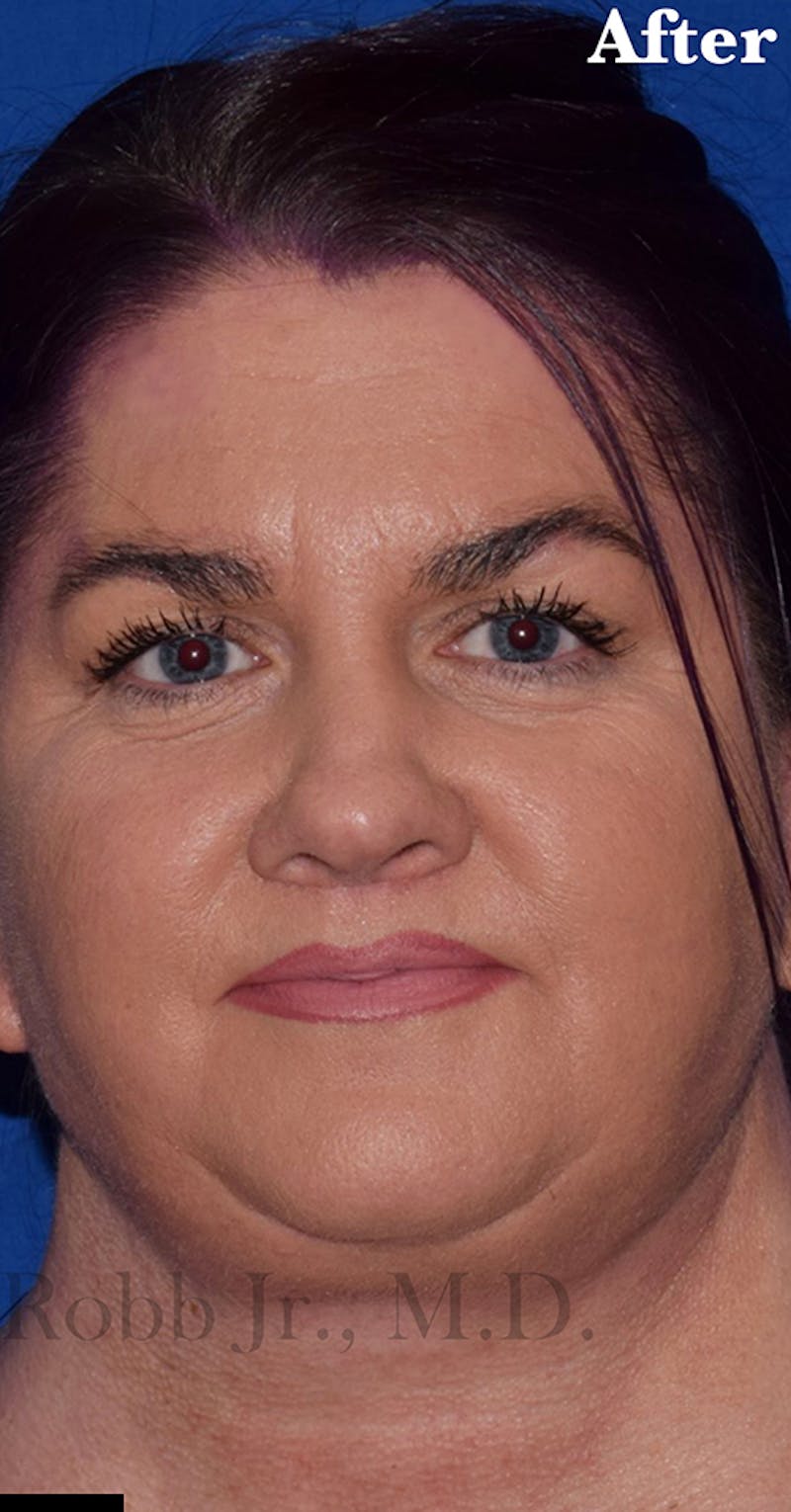 Face Before & After Gallery - Patient 63361217 - Image 2