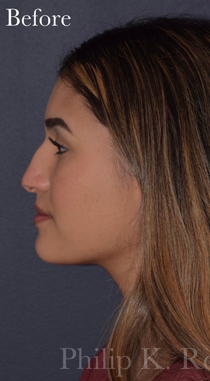 Cosmetic Surgical Before & After Gallery - Patient 63361219 - Image 7