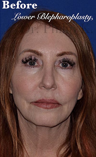 Face Before & After Gallery - Patient 63361220 - Image 1