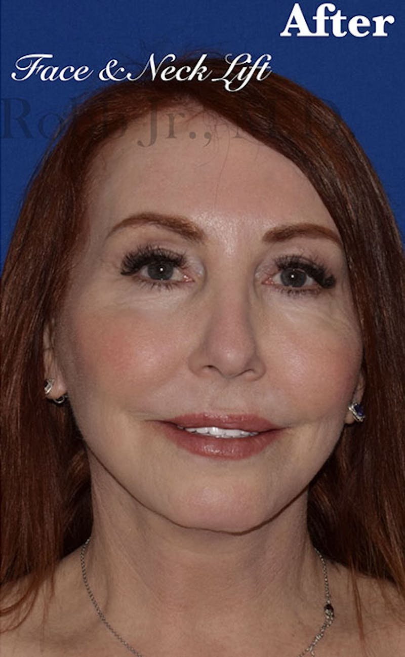Face Before & After Gallery - Patient 63361220 - Image 2