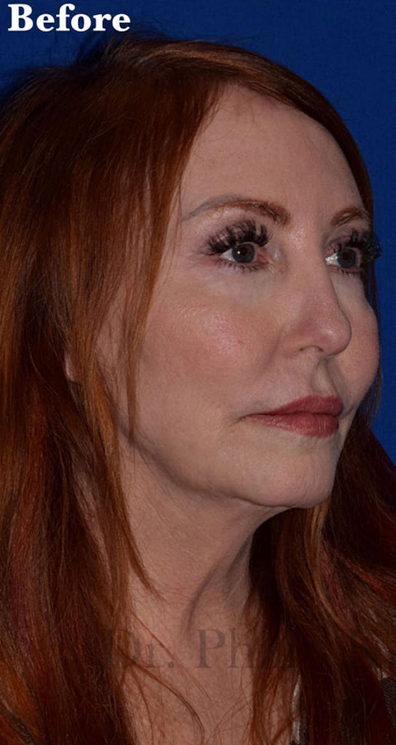 Face Before & After Gallery - Patient 63361220 - Image 3
