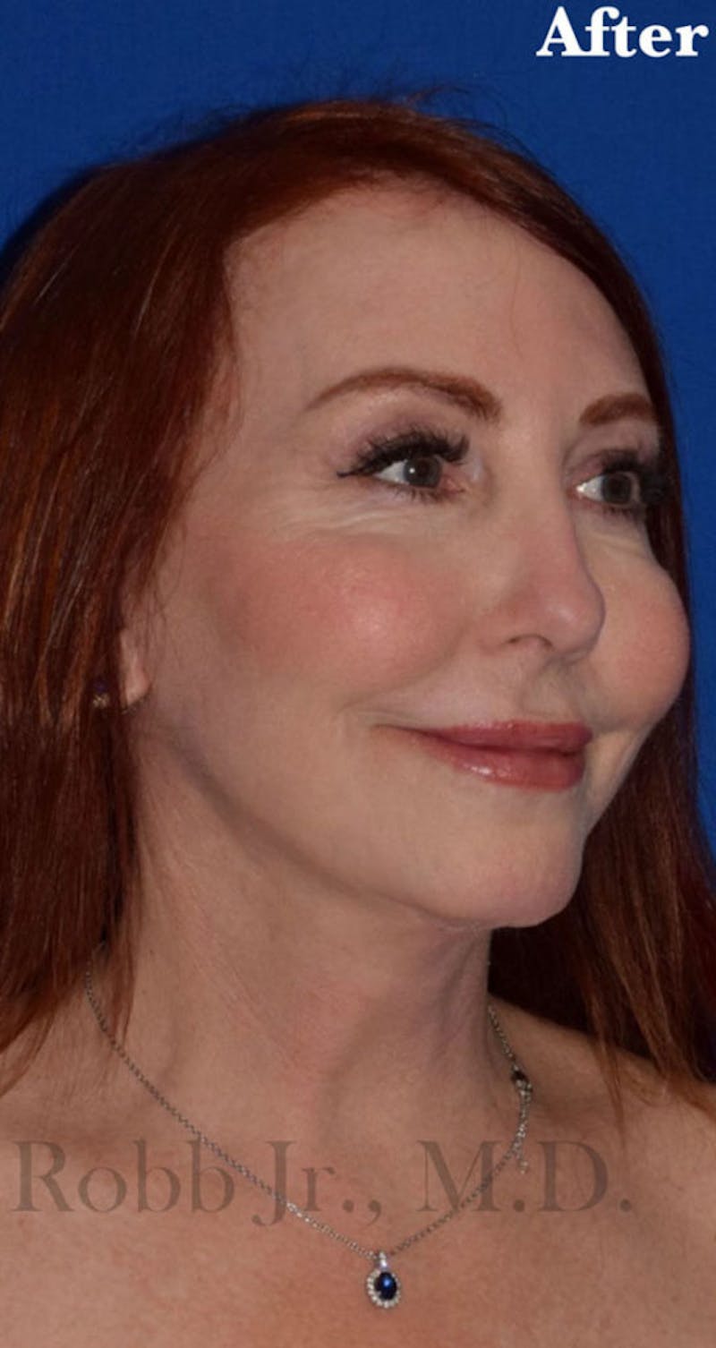 Face Before & After Gallery - Patient 63361220 - Image 4