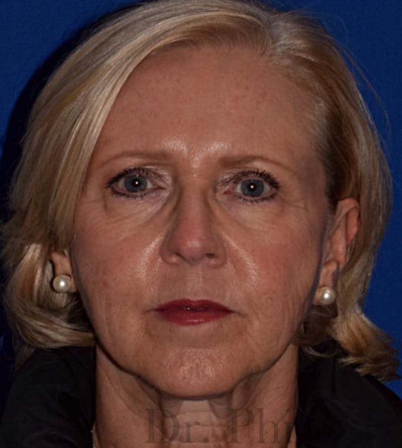 Face Before & After Gallery - Patient 63361222 - Image 1