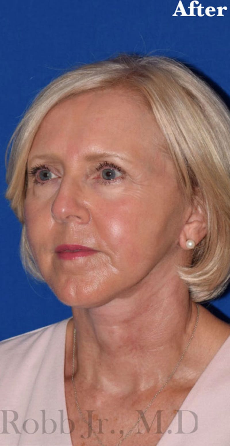 Face Before & After Gallery - Patient 63361222 - Image 4