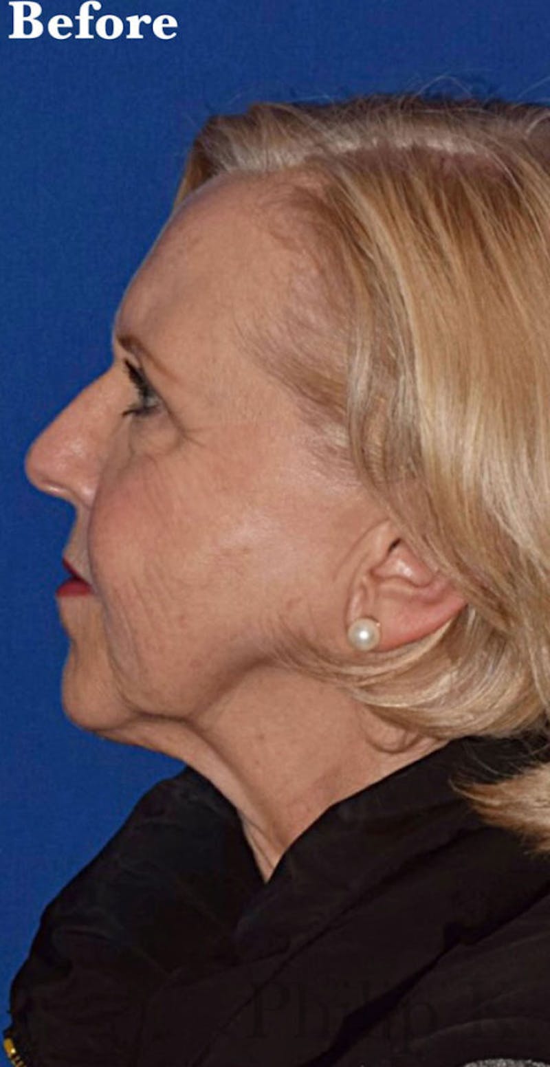 Face Before & After Gallery - Patient 63361222 - Image 5