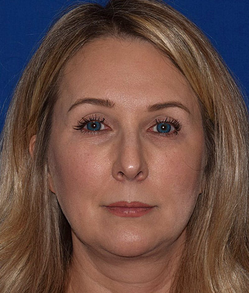 Face Before & After Gallery - Patient 63361224 - Image 1
