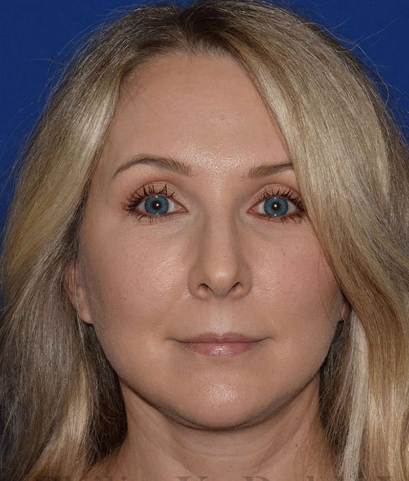 Face Before & After Gallery - Patient 63361224 - Image 2