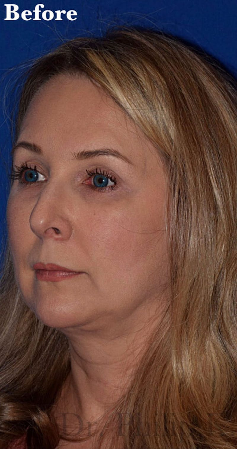 Face Before & After Gallery - Patient 63361224 - Image 3