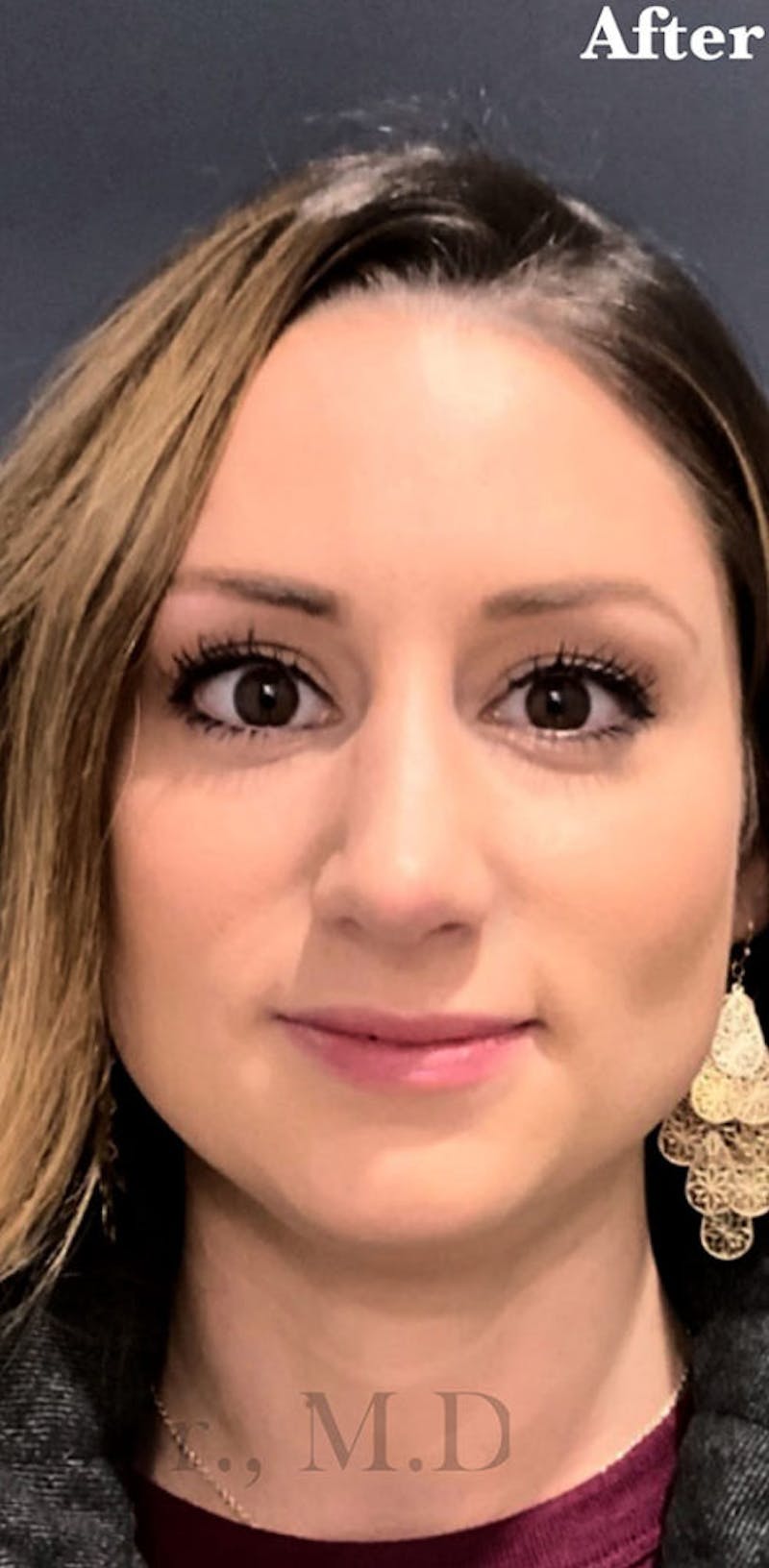 Cosmetic Surgical Before & After Gallery - Patient 63361225 - Image 4