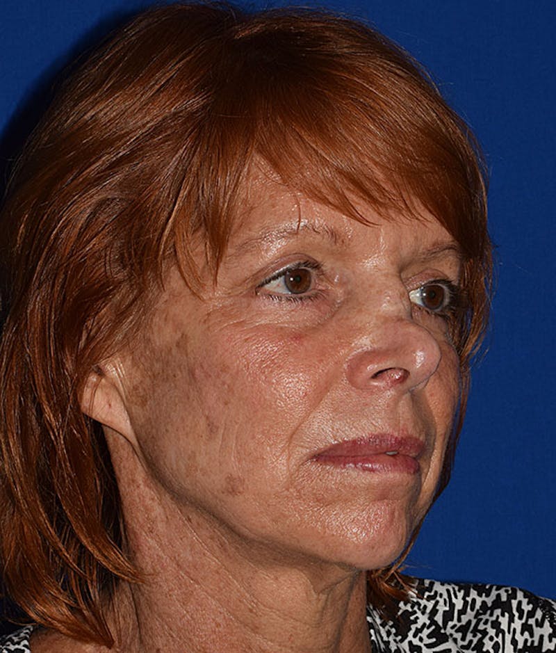 Cosmetic Surgical Before & After Gallery - Patient 63361226 - Image 3