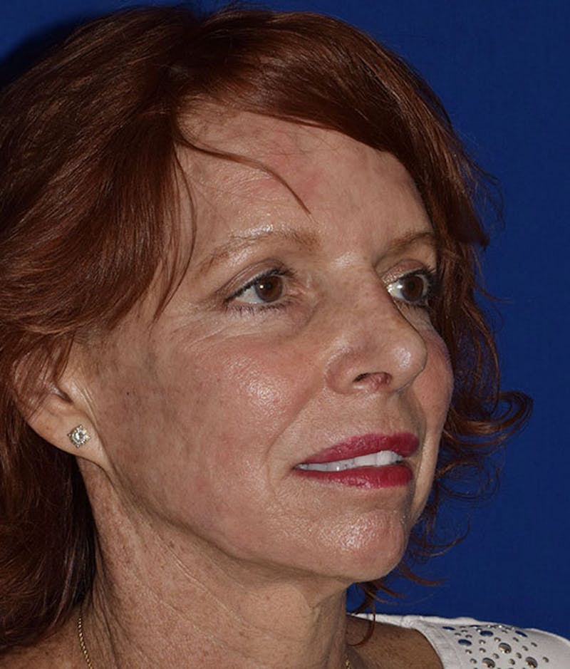Cosmetic Surgical Before & After Gallery - Patient 63361226 - Image 4