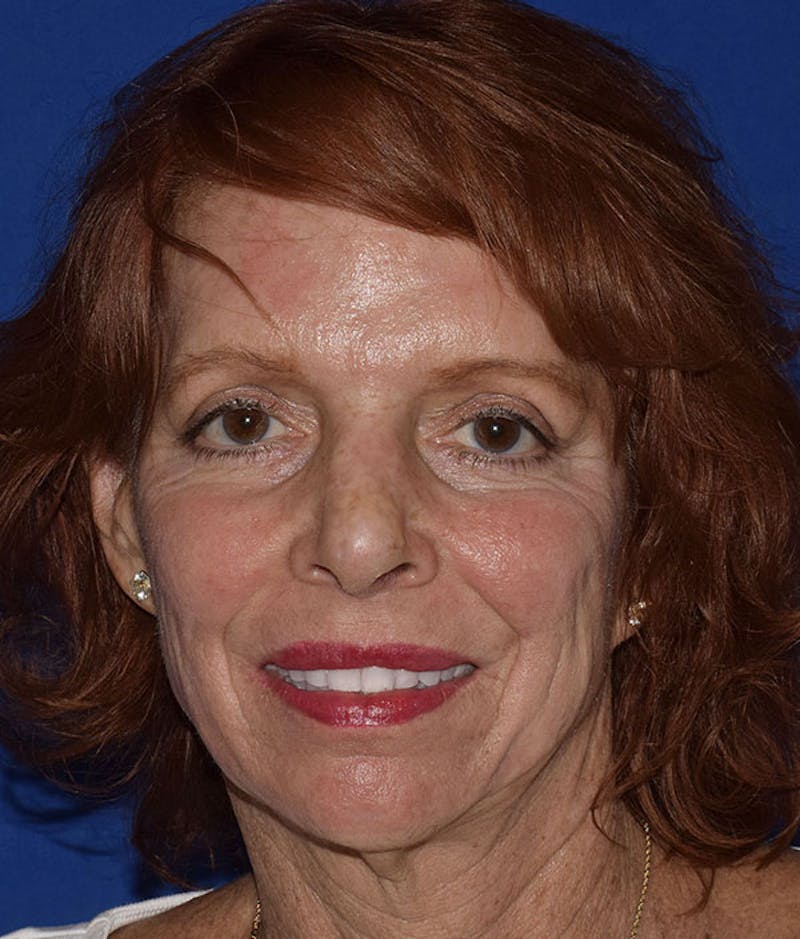 Cosmetic Surgical Before & After Gallery - Patient 63361226 - Image 6