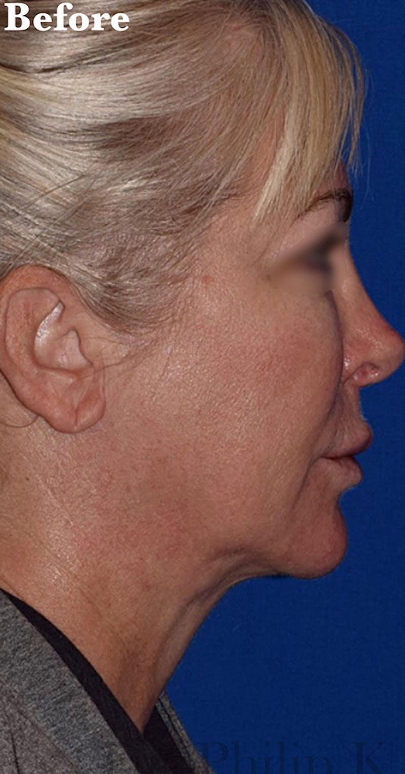 Face Before & After Gallery - Patient 63361232 - Image 1
