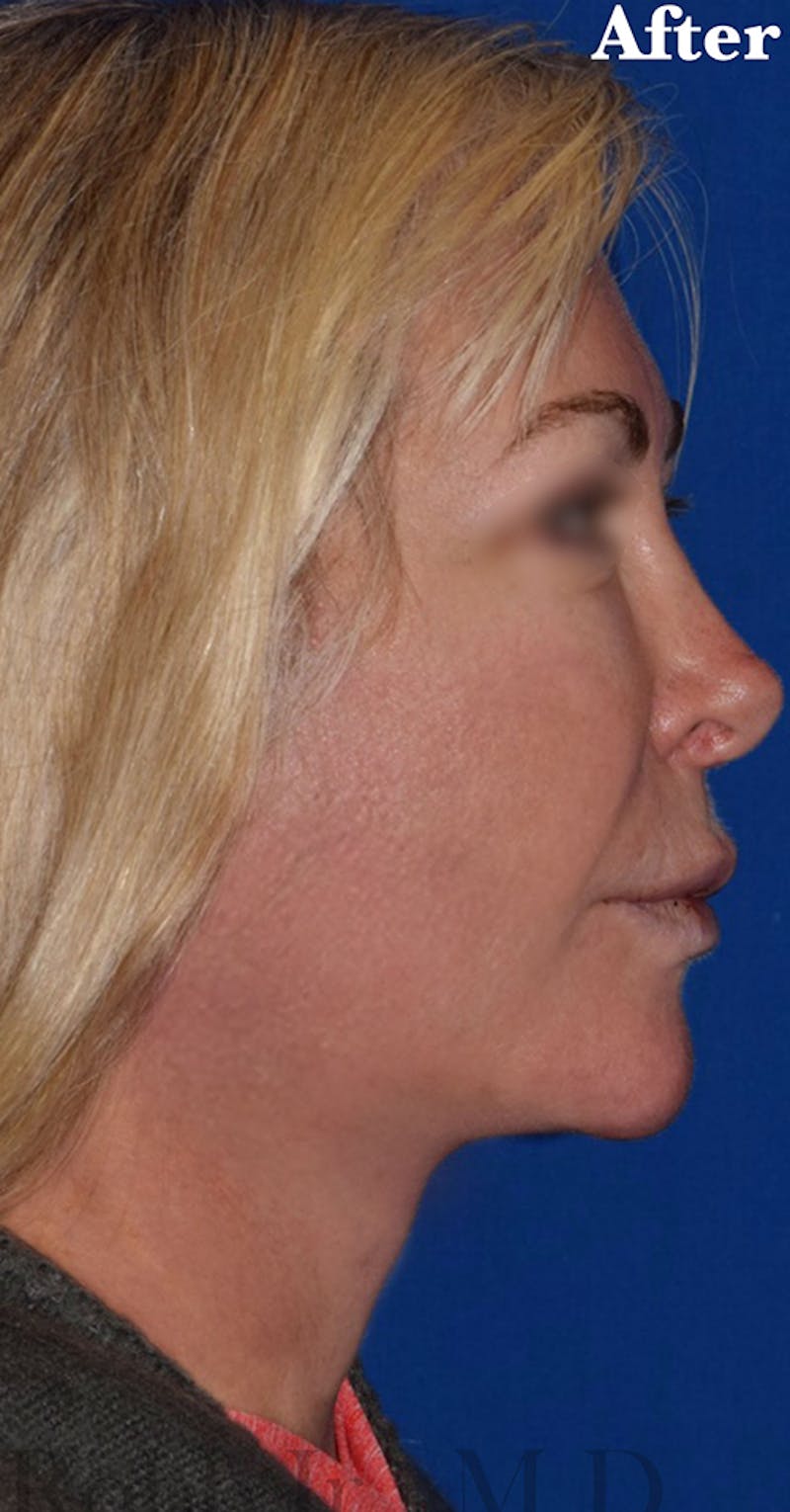 Face Before & After Gallery - Patient 63361232 - Image 2