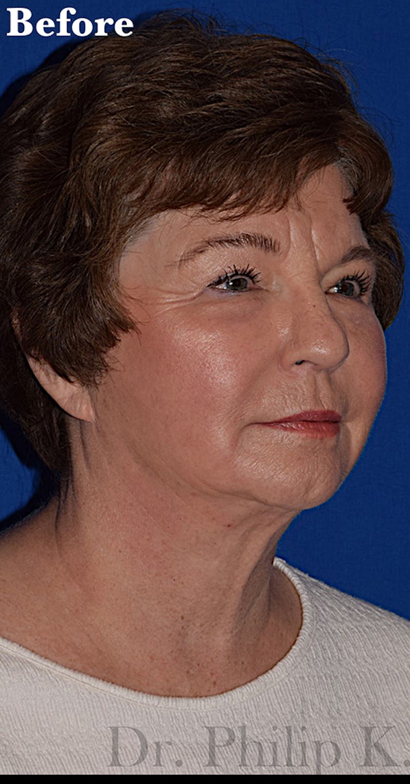 Face Before & After Gallery - Patient 63361234 - Image 1