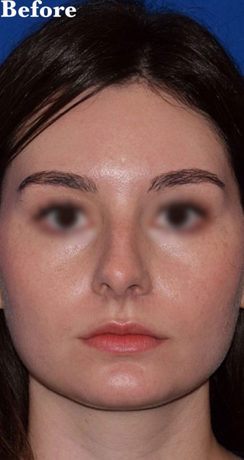 Cosmetic Surgical Before & After Gallery - Patient 63361235 - Image 1