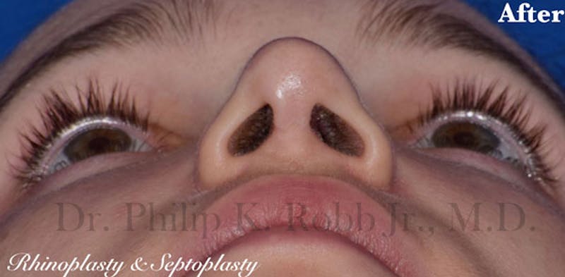 Cosmetic Surgical Before & After Gallery - Patient 63361239 - Image 4