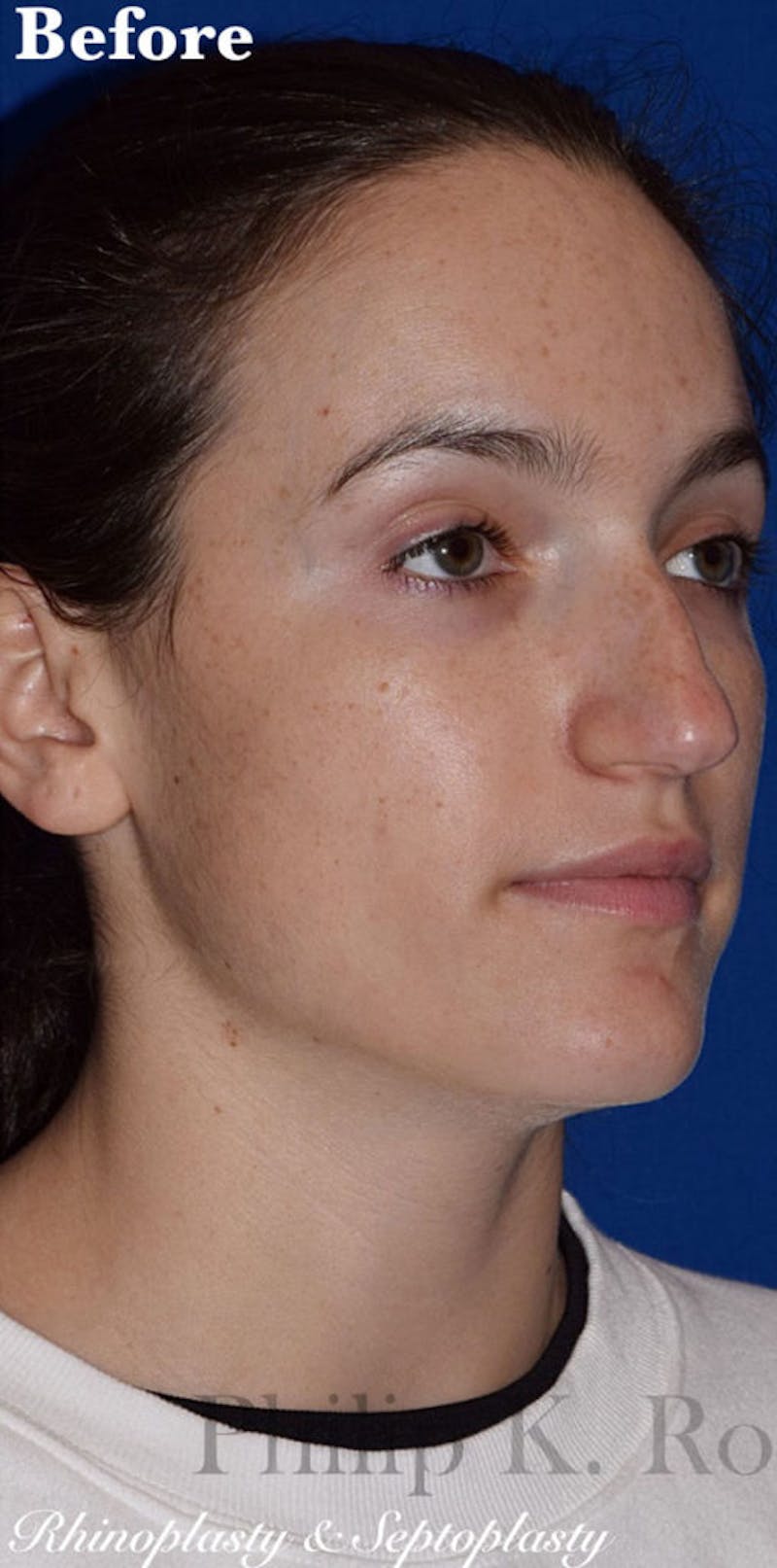 Cosmetic Surgical Before & After Gallery - Patient 63361239 - Image 5