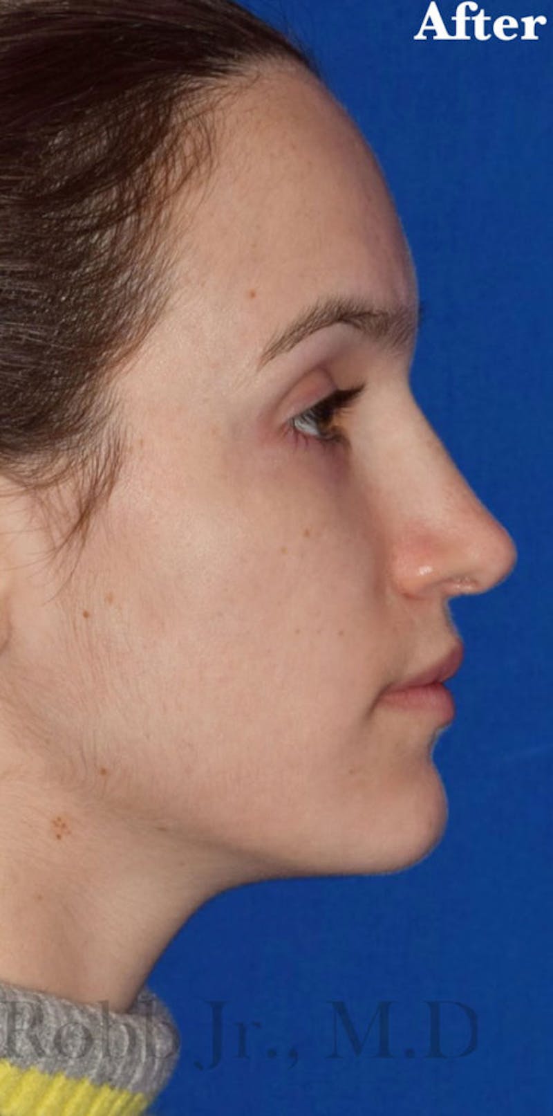 Cosmetic Surgical Before & After Gallery - Patient 63361239 - Image 8