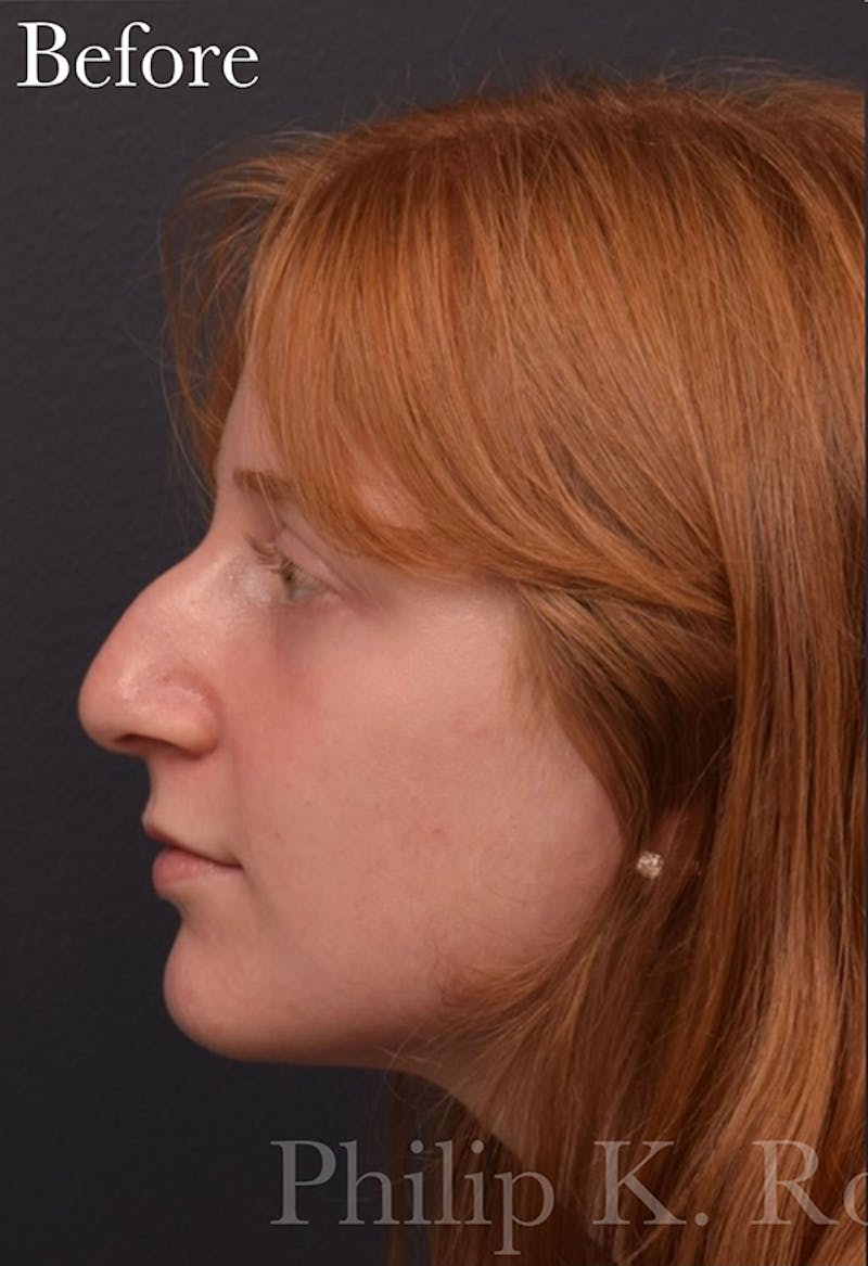 Cosmetic Surgical Before & After Gallery - Patient 63361290 - Image 5