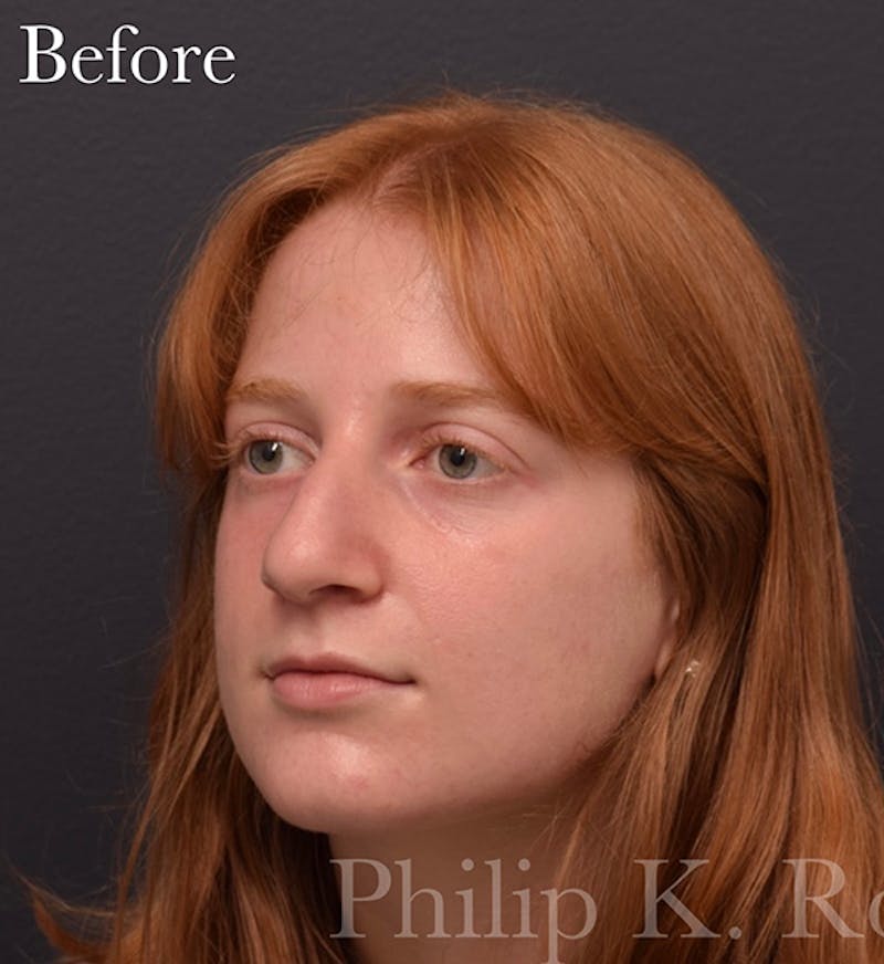 Cosmetic Surgical Before & After Gallery - Patient 63361290 - Image 9