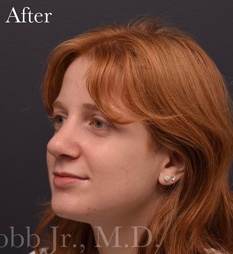 Cosmetic Surgical Before & After Gallery - Patient 63361290 - Image 10