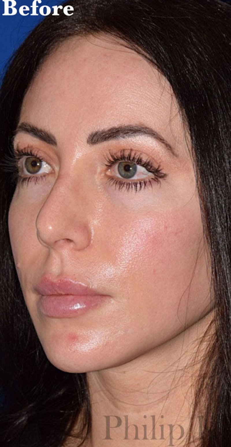 Cosmetic Surgical Before & After Gallery - Patient 63361306 - Image 3