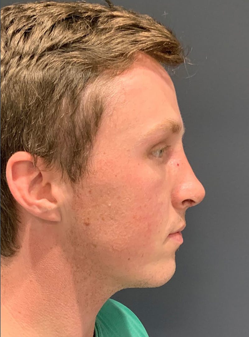 Face Before & After Gallery - Patient 63361319 - Image 4