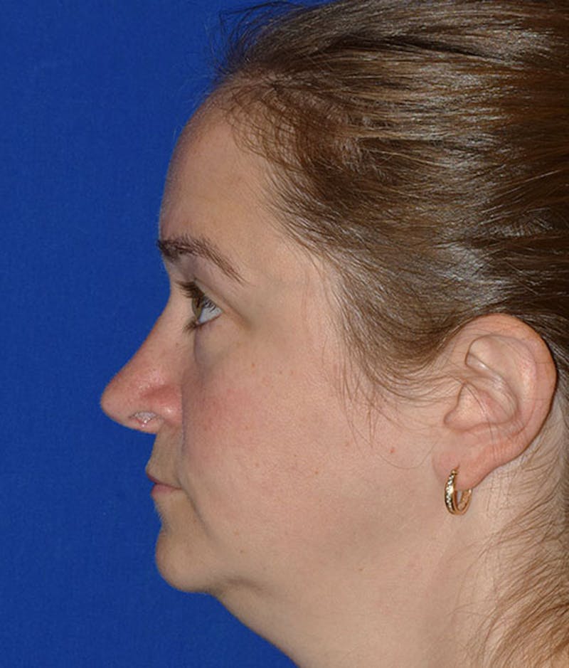 Face Before & After Gallery - Patient 63361353 - Image 2