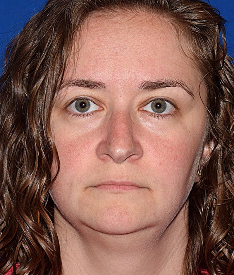 Cosmetic Surgical Before & After Gallery - Patient 63361353 - Image 5