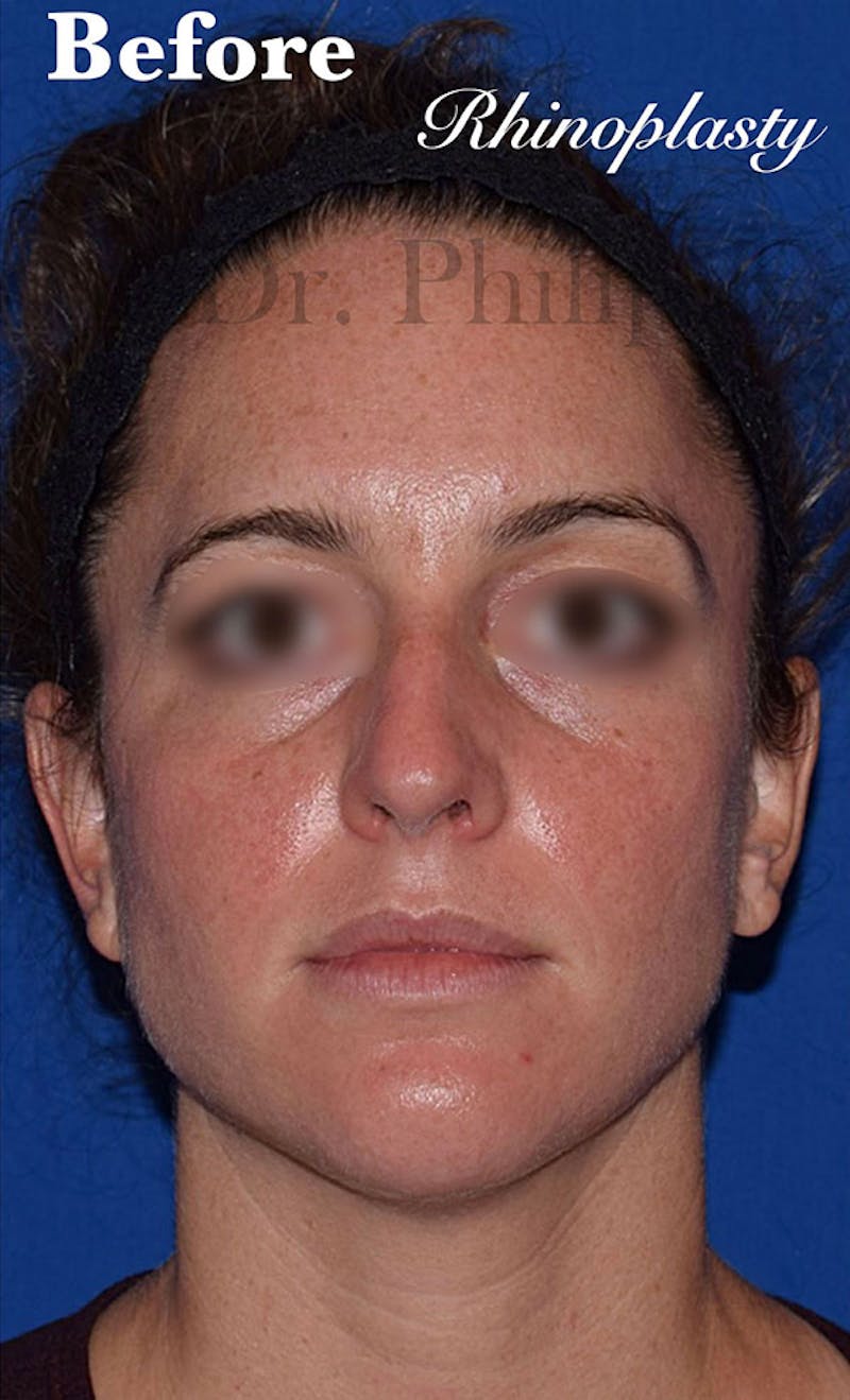 Cosmetic Surgical Before & After Gallery - Patient 63361383 - Image 1