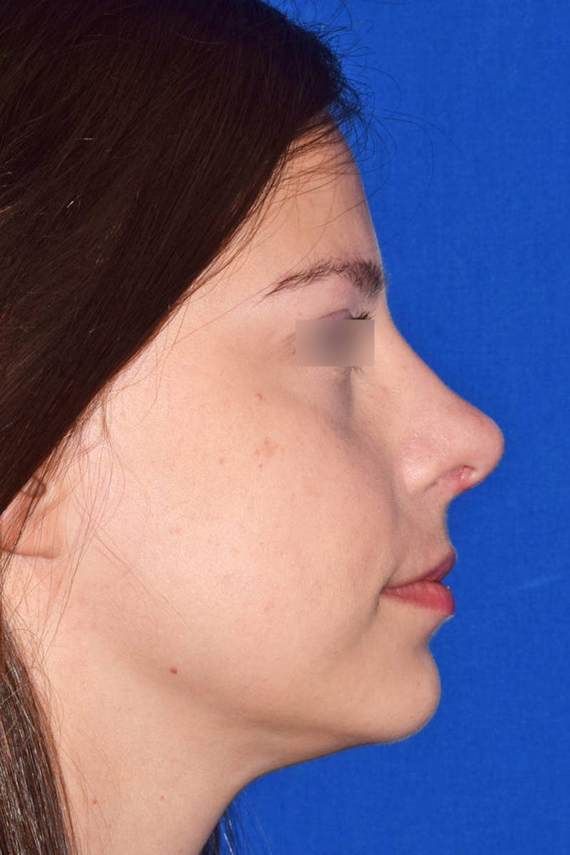 Face Before & After Gallery - Patient 63361384 - Image 2
