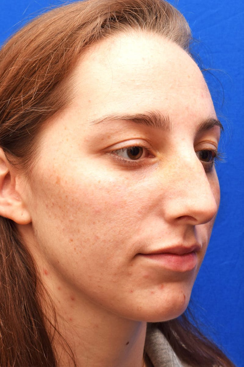 Cosmetic Surgical Before & After Gallery - Patient 63361388 - Image 3