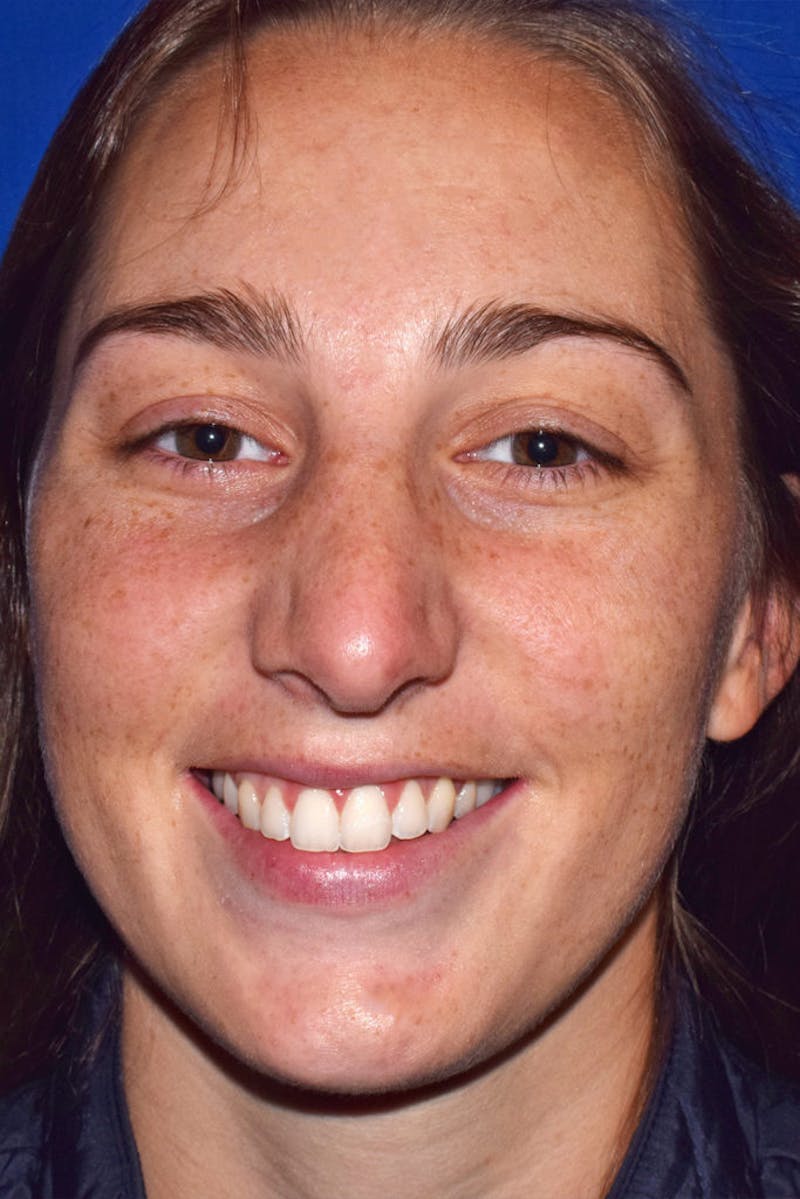 Cosmetic Surgical Before & After Gallery - Patient 63361388 - Image 6