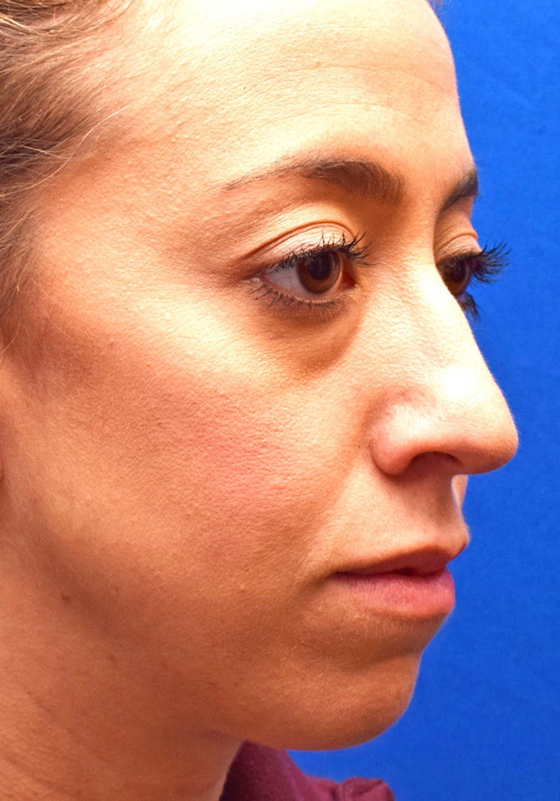 Cosmetic Surgical Before & After Gallery - Patient 63361404 - Image 3