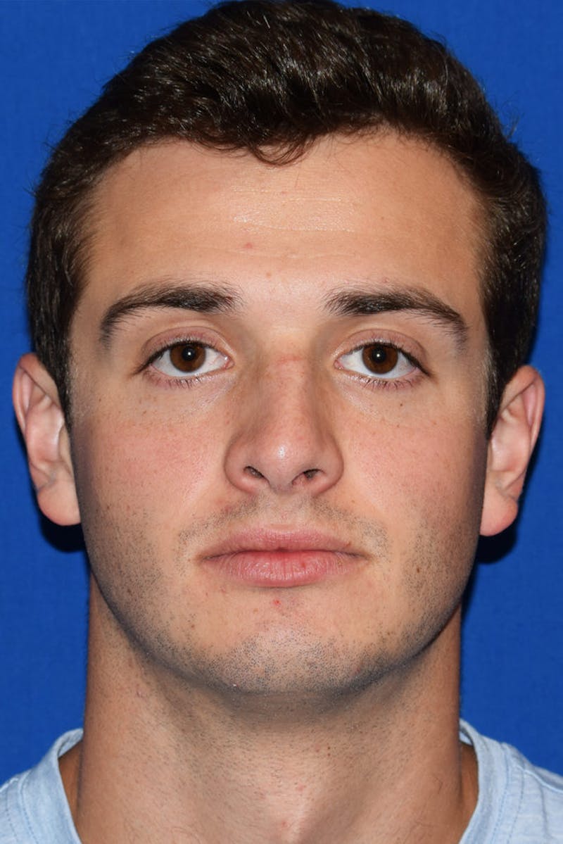 Face Before & After Gallery - Patient 63361414 - Image 7