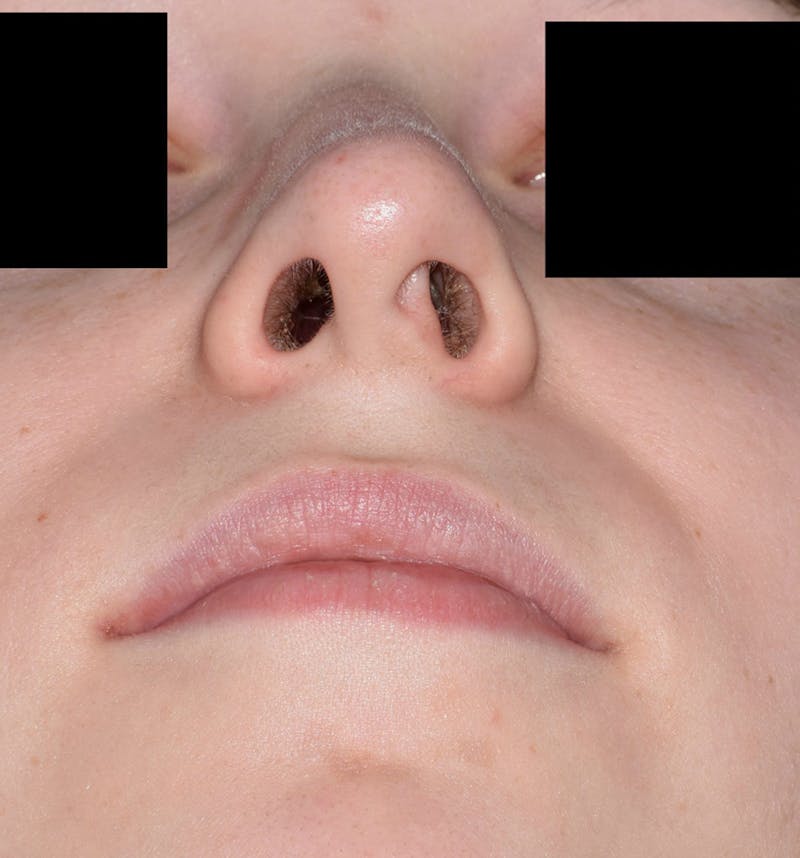 Cosmetic Surgical Before & After Gallery - Patient 63361424 - Image 1