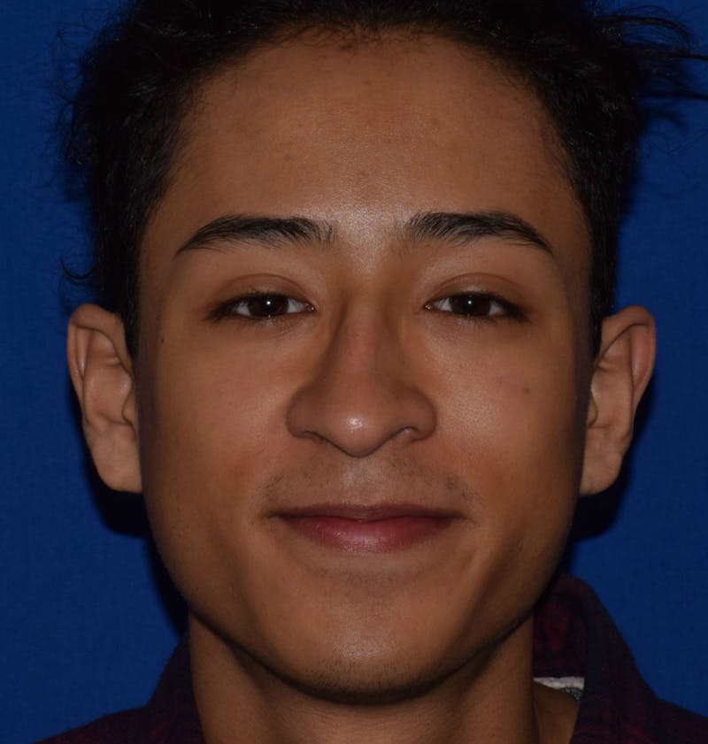 Cosmetic Surgical Before & After Gallery - Patient 63361431 - Image 3