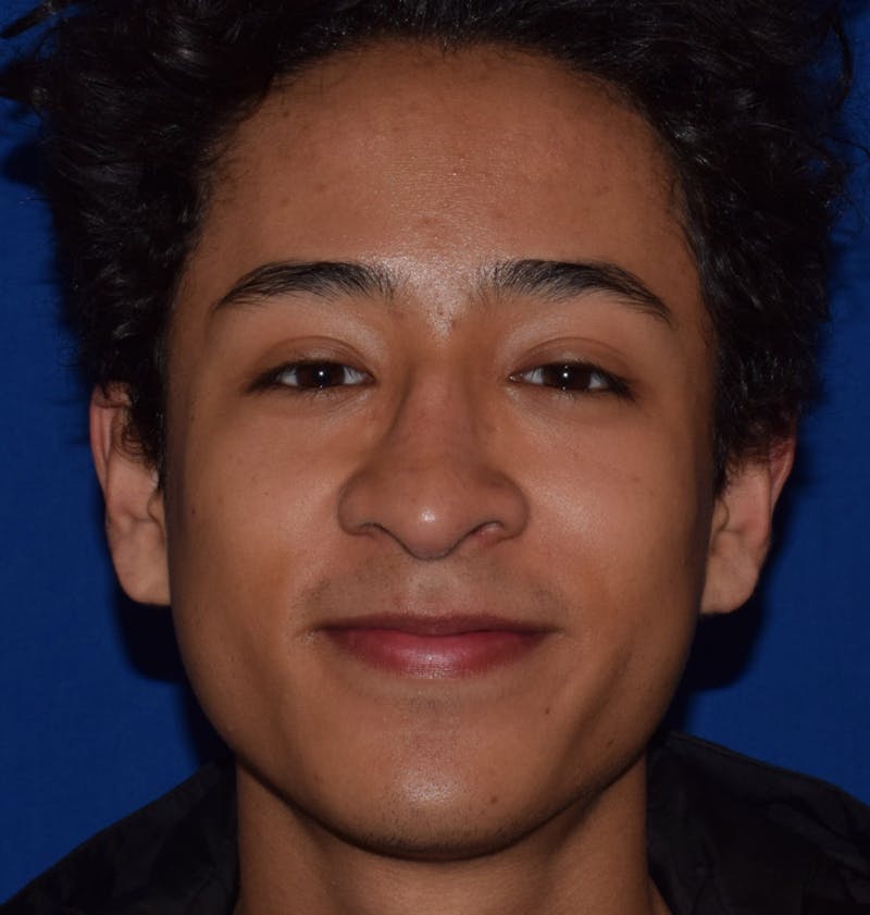 Cosmetic Surgical Before & After Gallery - Patient 63361431 - Image 4