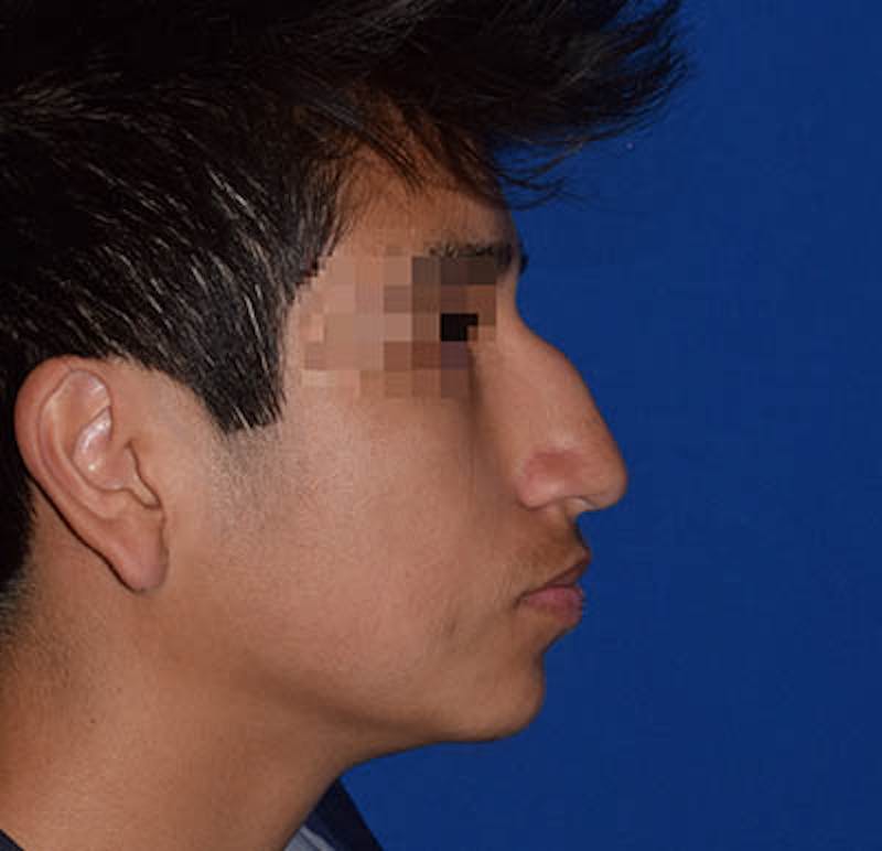 Cosmetic Surgical Before & After Gallery - Patient 63361432 - Image 1
