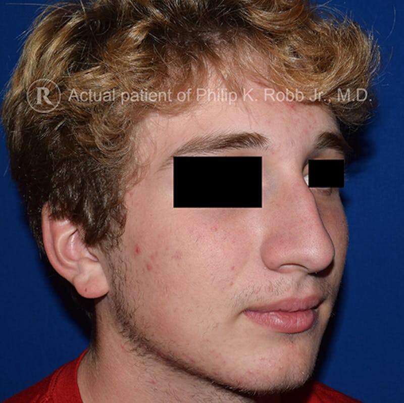 Cosmetic Surgical Before & After Gallery - Patient 63361433 - Image 3