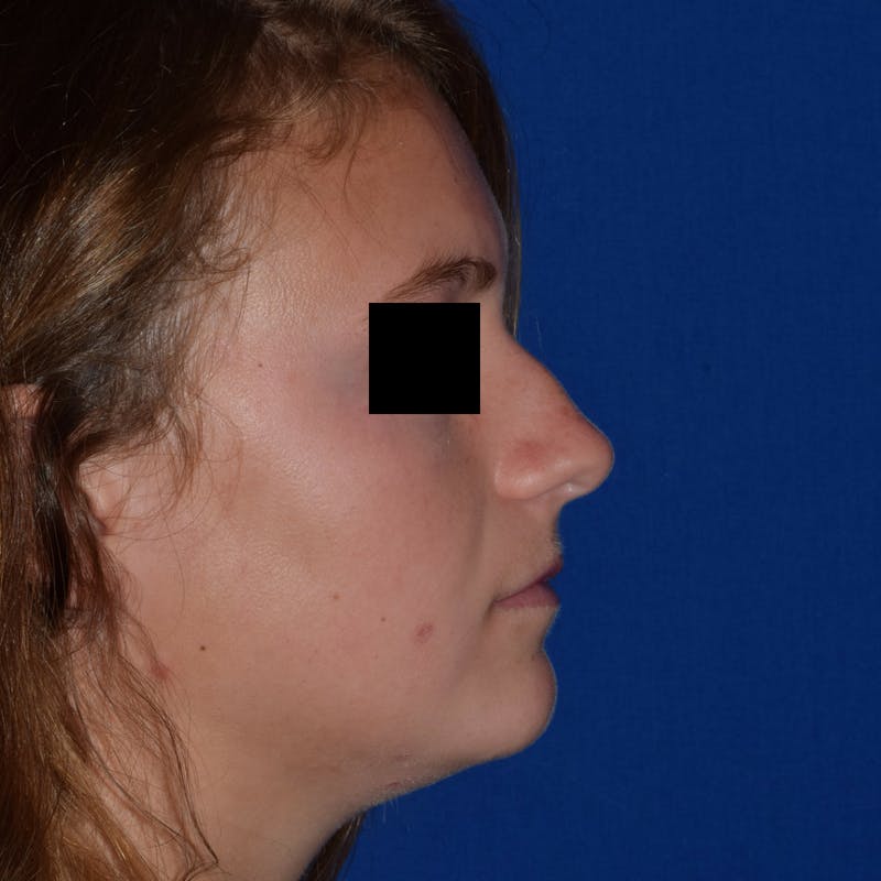 Cosmetic Surgical Before & After Gallery - Patient 63361435 - Image 1
