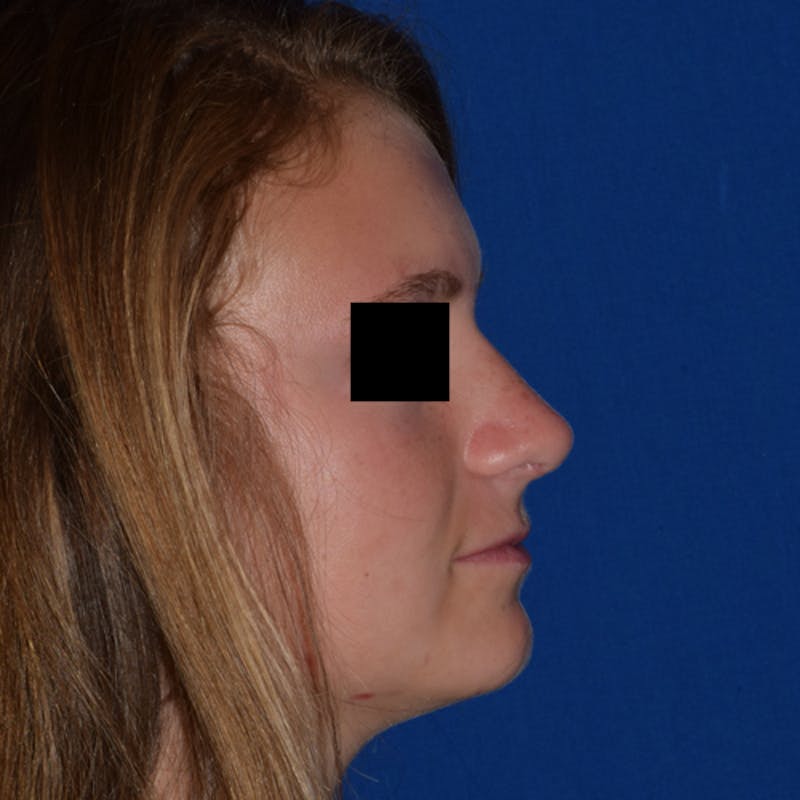 Cosmetic Surgical Before & After Gallery - Patient 63361435 - Image 2