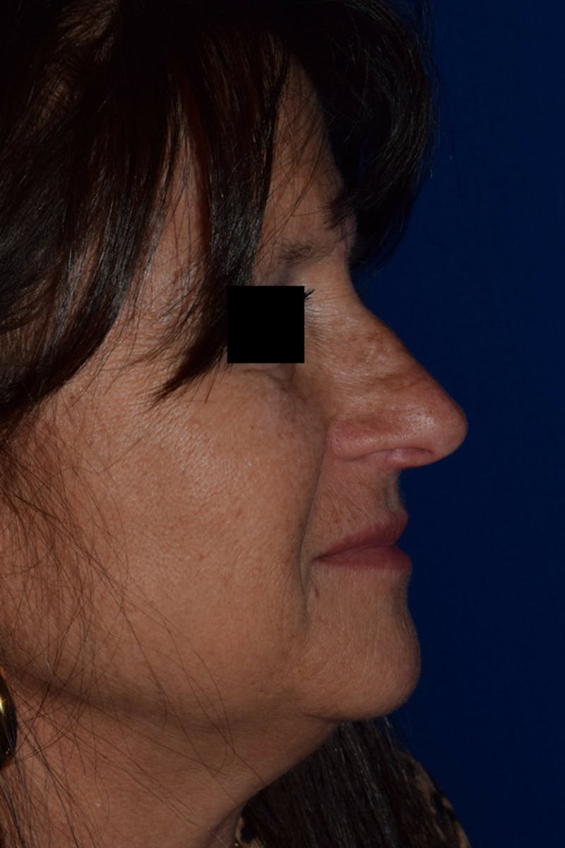 Cosmetic Surgical Before & After Gallery - Patient 63361437 - Image 1
