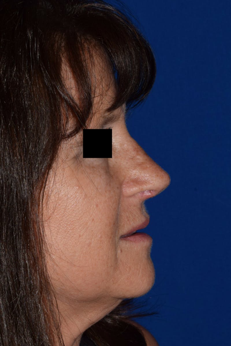 Cosmetic Surgical Before & After Gallery - Patient 63361437 - Image 2