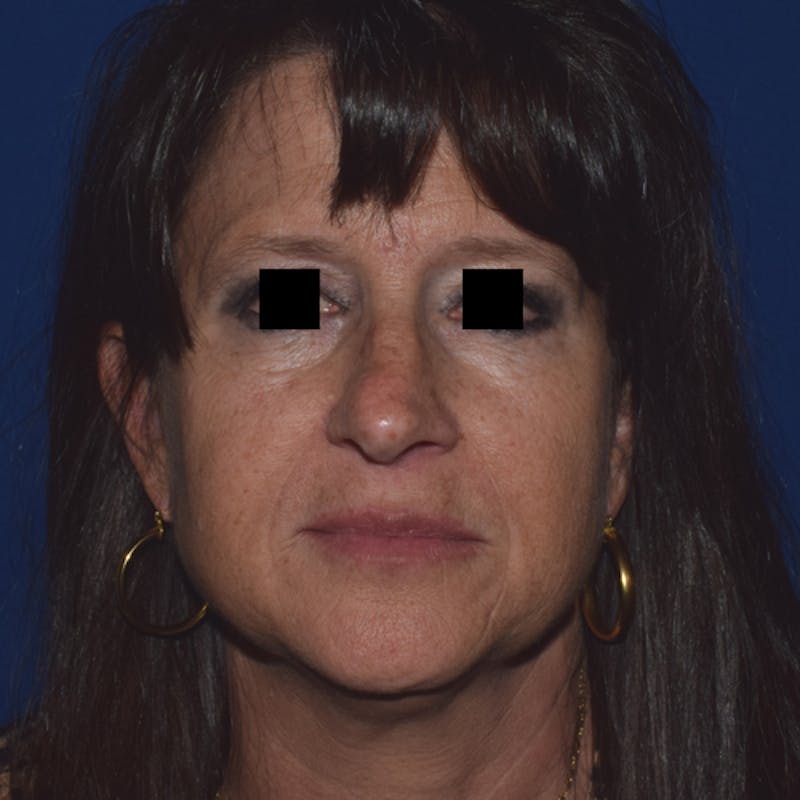 Cosmetic Surgical Before & After Gallery - Patient 63361437 - Image 3