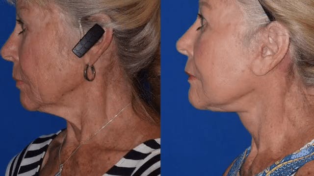Robb Facial Plastic Surgery